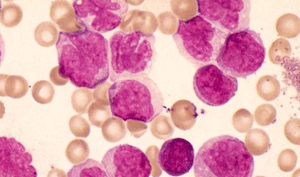 leucemiafarmacodiabete