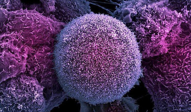 Tumori: individuata la proteina che produce metastasi