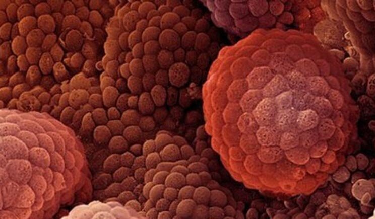Un uomo su due ignora i sintomi del cancro alla prostata