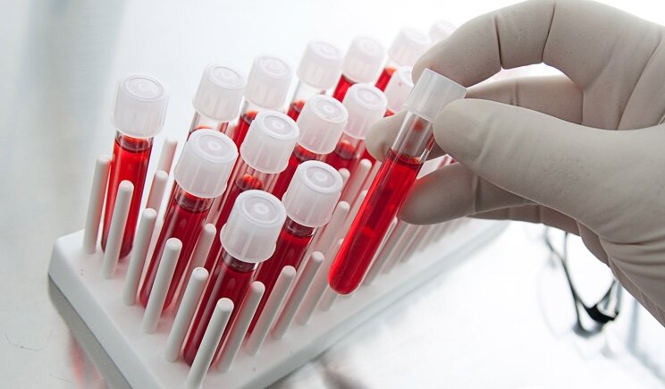 Tumori: diagnosi precoce grazie ad un esame del sangue hi-tech