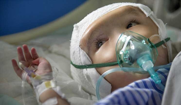 Trapianto di cranio in 3D effettuato su una bambina di 3 anni