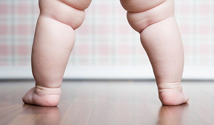 Bambina di tre anni arriva a pesare 35 chili per colpa del diabete